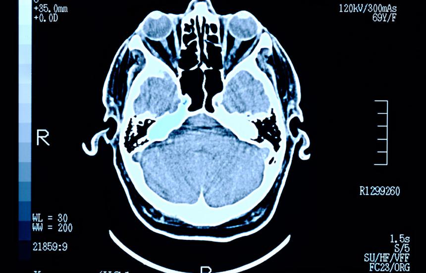 Cognitive Decline